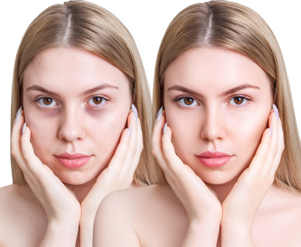 i-m-tired-of-puffy-dark-under-eye-circles-is-under-eye-filler-safe