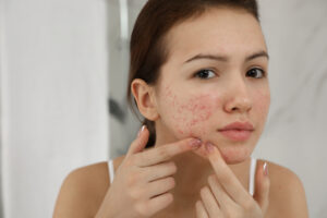 Acne Specialist in Columbia Maryland