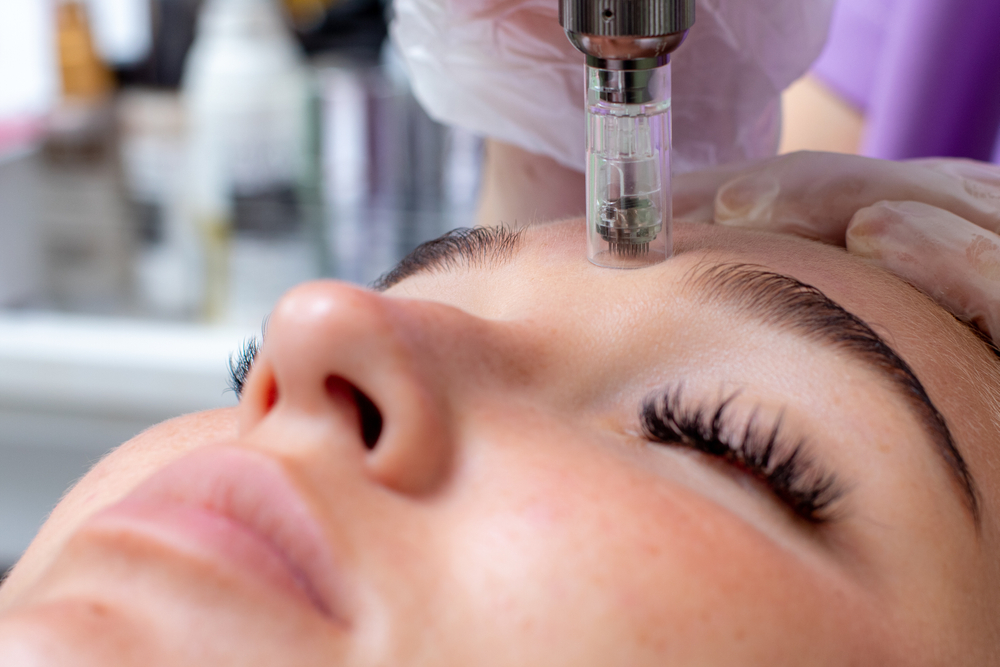How Much Is Microneedling in Columbia, Maryland?